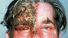 Herpes Zoster Vaccine Can Save Your Patients' Eyesight