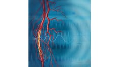 Fast Five Quiz: Type 2 Diabetes and Peripheral Artery Disease