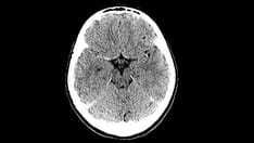 Transient Vision Loss and Facial Spasms