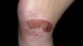 Topical Gel for Epidermolysis Bullosa Shows Ongoing Benefit