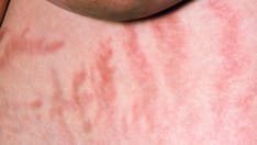 Endo Case Challenge: Amenorrhea for Months, Mood Swings, Weight Gain in a 38-Year-Old Woman