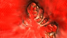 Concern Over US Hospital Patient Information on LAA Closure