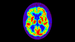 Similar Brain Atrophy in Obesity and Alzheimer's Disease