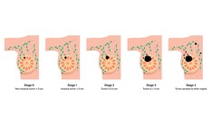 Fast Five Quiz: AKT in Advanced and Metastatic Breast Cancer