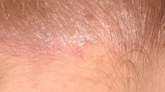 Fast Five Quiz: Scalp Psoriasis Overview