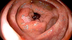 Crohn Disease: Practice Essentials, Background, Pathophysiology