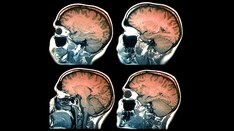 Fast Five Quiz: Multiple Sclerosis Comorbidities