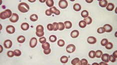 Hematologic Complications After Femoral Fracture Surgery