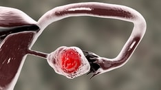 Fast Five Quiz: Ovarian Cancer Presentation and Diagnosis