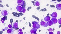 Fast Five Quiz: Triple-Class-Exposed Relapsed/Refractory Multiple Myeloma