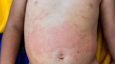 Fast Five Quiz: Pediatric Food Allergy Signs and Symptoms