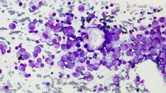 Fast Five Quiz: Immunotherapy for Multiple Myeloma