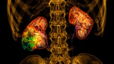 Renal Cell Carcinoma: 5 Things to Know About the Latest Developments