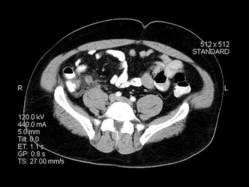 Pain and Constipation in a Woman on a Low-Carb Diet - Page 4