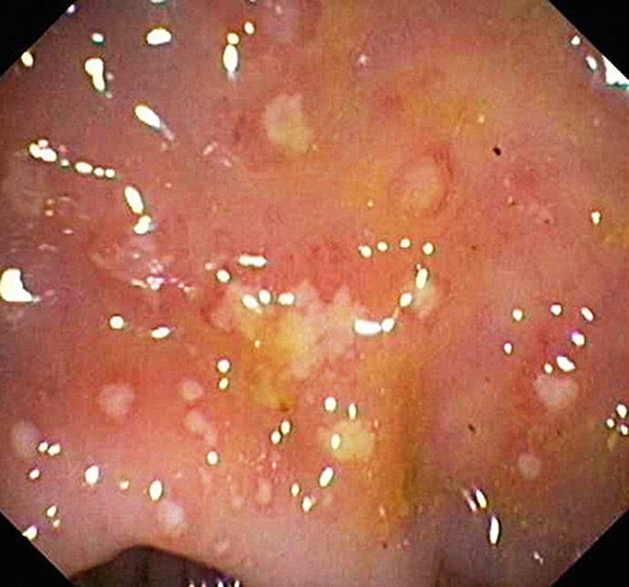 Diarrhea And Chills In A Patient With Copd - Page 3