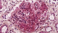 Fast Five Quiz: Can You Manage Patients With Systemic Lupus Erythematosus?