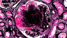 Rapid Review Quiz: Immunoglobulin A Nephropathy Prognosis