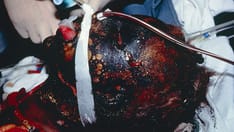 Burn Injuries: Complications and Care Options