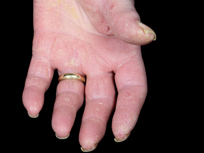 Psoriatic Arthritis: Ruling Out the Mimics