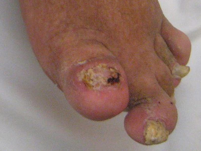 Psoriatic Arthritis: Available Interventions