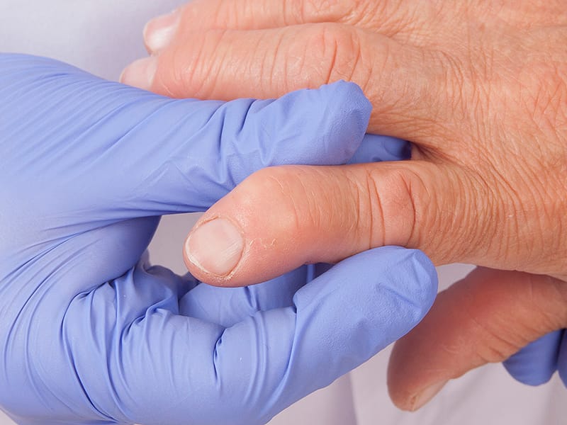 Rheumatoid Arthritis: Dual Management