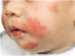 New Study Describes Relationship Between Atopic Dermatitis and Food Allergy