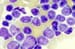 Acute Lymphoblastic Leukemia