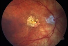 Topical Antibiotics After Eye Injections May Be Harmful