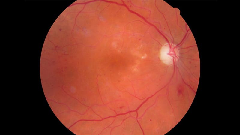 Bariatric Surgery May Curb Diabetic Eye Disease Incidence but Worsen Existing Retinopathy