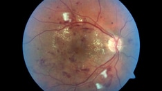 Steroid Implants Best for Improving Vision in Uveitis ME