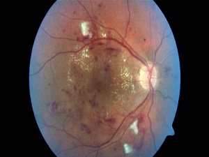 Macular Edema Treatments Less Effective in the Real World
