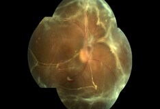 Iritis And Uveitis Practice Essentials Background Pathophysiology