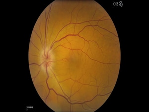 Erythropoietin Falls Short of Neuroprotection in Optic Neuritis