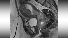 Cervical Cancer: Beyond the Pap