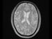 New Recommendations on MRI Diagnosis of Multiple Sclerosis