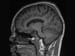 No Harm Seen in MRI Gadolinium Retention in Brain, FDA Says