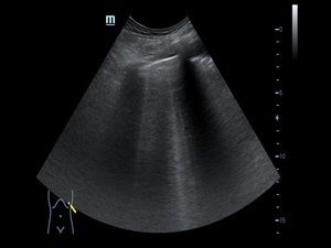 Ultrasound 'Lung Comets' Hint Value as Treatment Target in HF