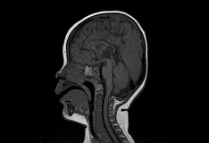 Pelizaeus-Merzbacher Disease: Background, Etiology, Epidemiology