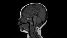 Pelizaeus-Merzbacher Disease: Background, Etiology, Epidemiology
