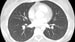 Pulmonary Function Tests Not a Good Substitute in ILD Screening