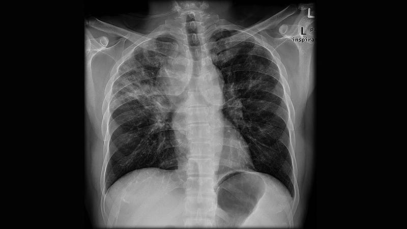 Lung Disease Raises Mortality Risk in Older RA Patients