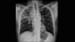 Lung Disease Raises Mortality Risk in Older RA Patients