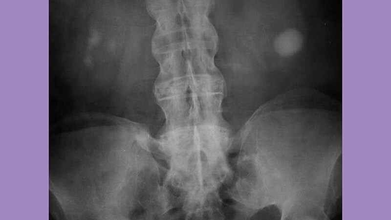 Tofacitinib Effective for Ankylosing Spondylitis in Phase 3