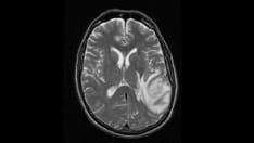 Long-Term Temozolomide in Patients With Glioblastoma