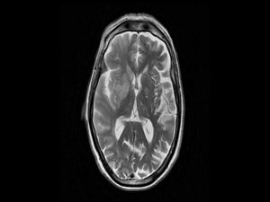 Tenecteplase Non-inferior to Alteplase in Stroke: ATTEST-2