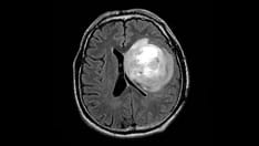 Total Resection for Glioblastoma Predicts Longer Survival