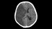 Tenecteplase Noninferior to Alteplase for Ischemic Stroke: TRACE-2