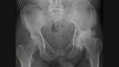 Hospital for Special Surgery and Arthritis Foundation Spotlight Neglected Hip Osteoarthritis Research