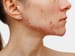 FDA Advisory Panel Backs OTC Adapalene Gel 0.1% for Acne