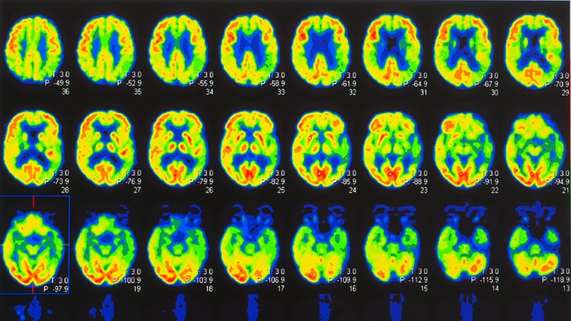 Brain's Metabolic Run-up to Dementia Directly Linked to HTN 